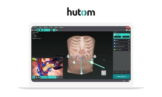 복강경 수술 내비게이션 'RUS' / 사진=휴톰